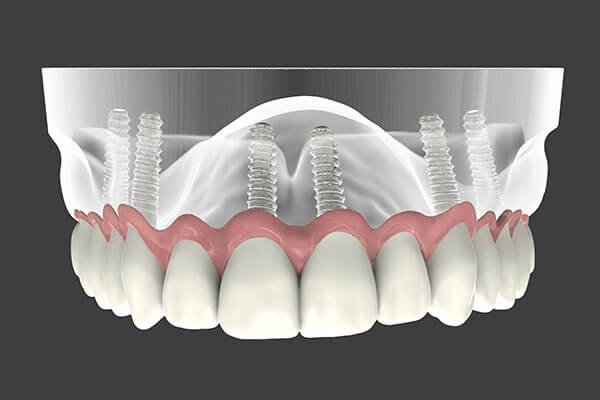 Dental Implant Supported Dentures in Morgan Hill