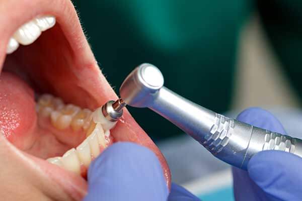 Closeup of professional dental cleaning