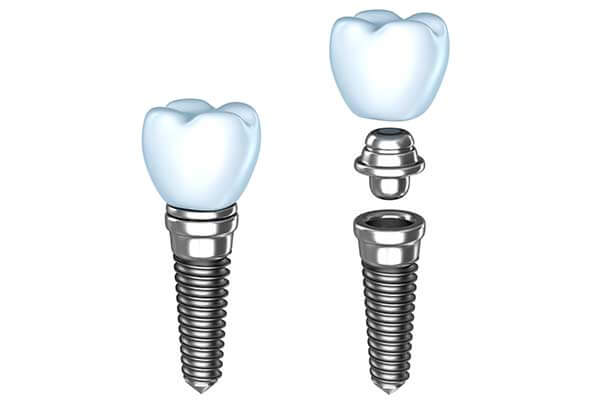 Single Dental implants in Morgan Hill