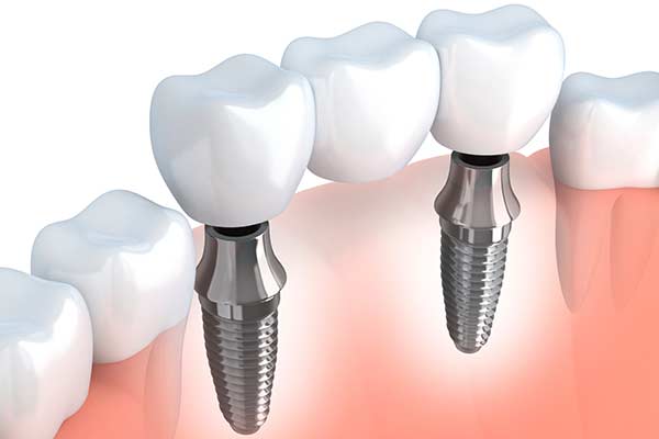 Dental Implant Supported Bridges in Morgan Hill