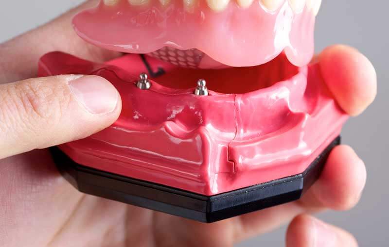 Mini Dental Implants in Morgan Hill, CA